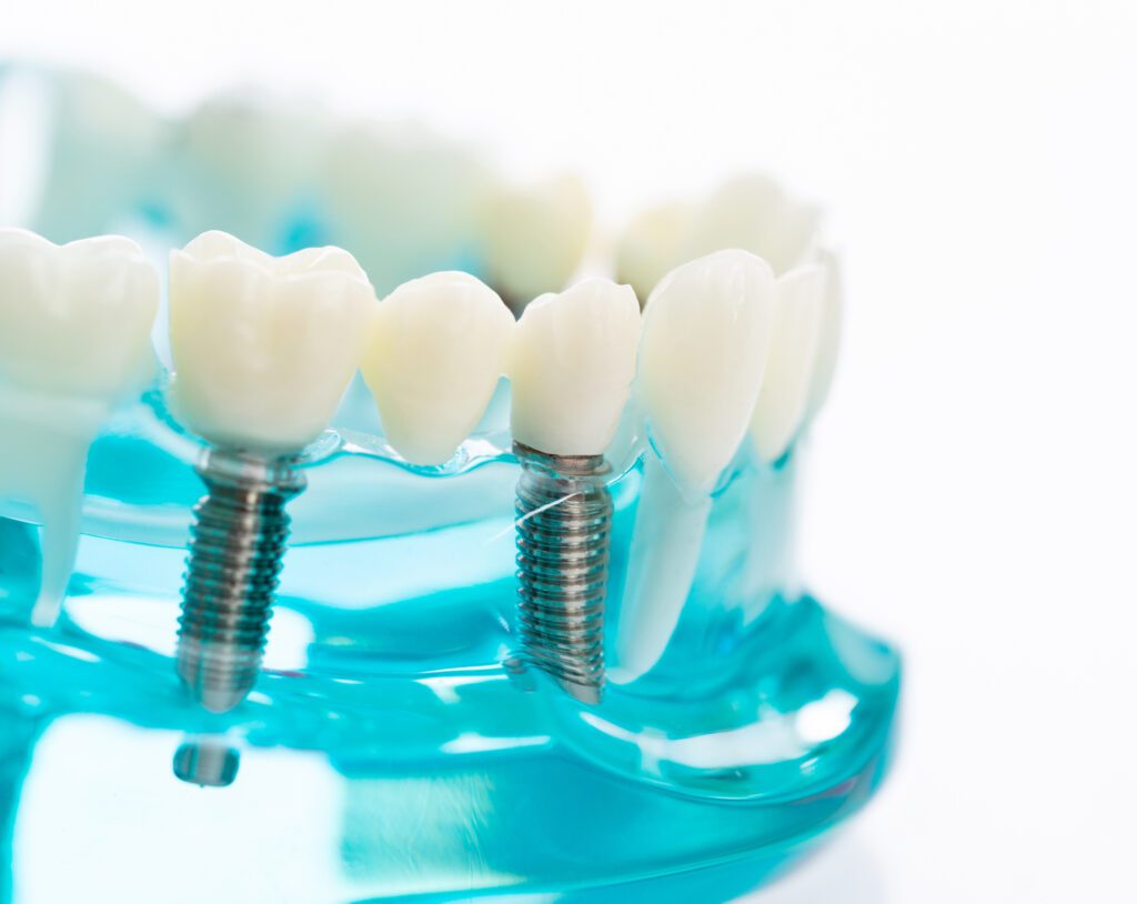 Dental Implant Benefits in Lexington, MA