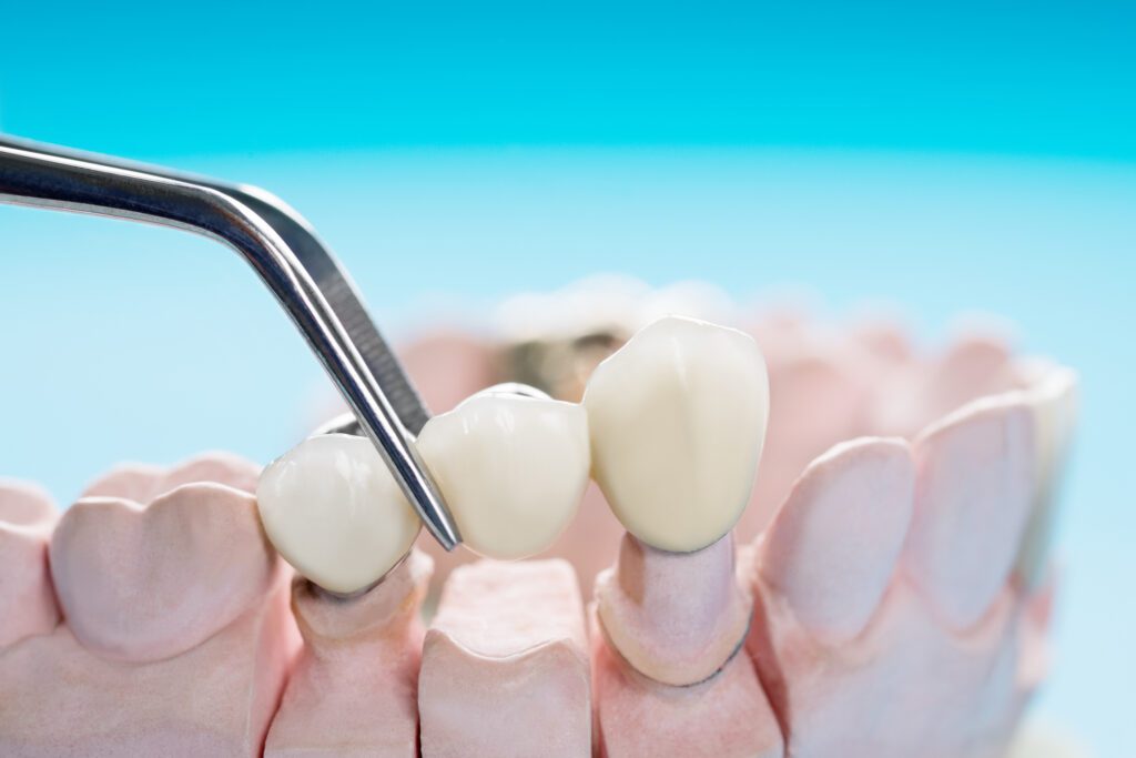 Multiple Dental Implants in Lexington, MA