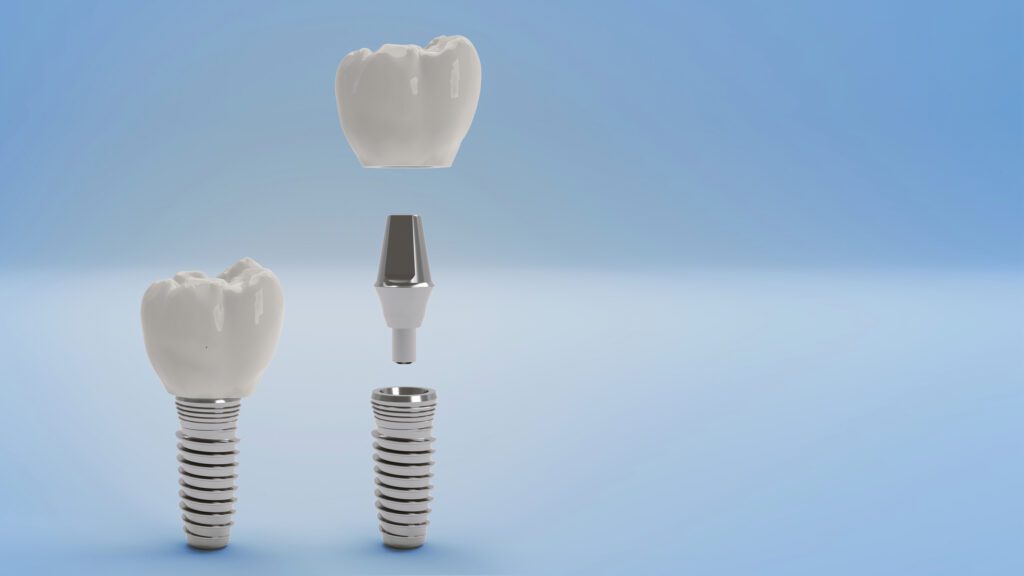The Dental Implant Procedure in Lexington MA