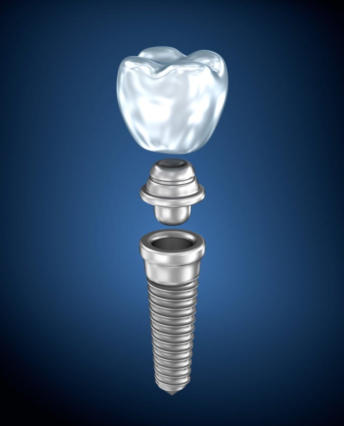 What Are Dental Implants in Lexington MA