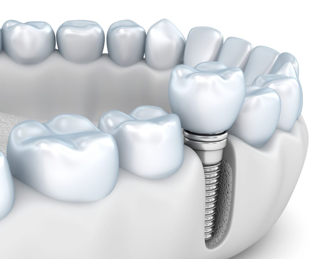 Bone Loss and Dental Implants