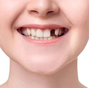 girl having a missing tooth, need to replace that