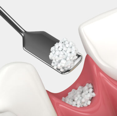 Lexington Dental clinic treatment image during Jaw structure restoration