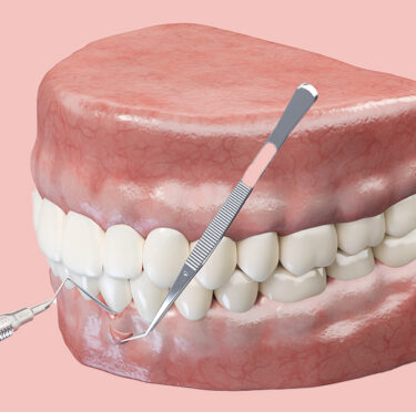 Achieve-a-Balanced-Smile-with-Precision-Gum-Contouring