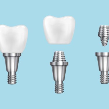 Concord Lexington dental clinic mini dental implant model