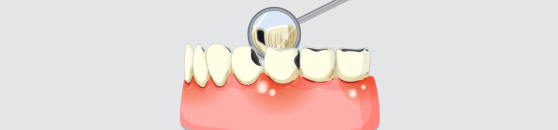 How to Prevent After Periodontal Disease Treatment