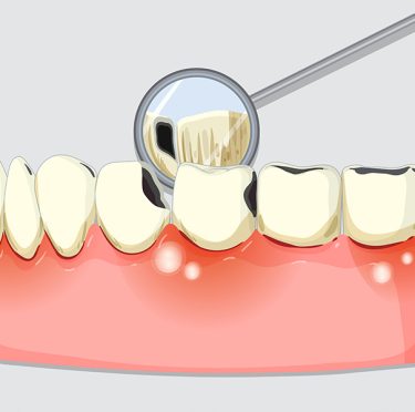 How to Prevent After Periodontal Disease Treatment