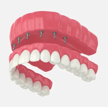 Implant-Supported-Dentures-Process,-Benefits-&-Care